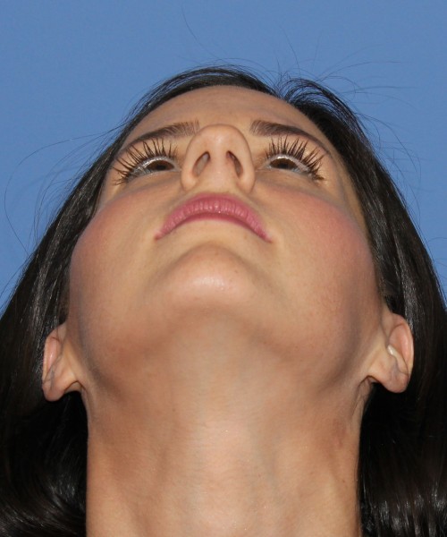 Rhinoplasty 4408 – Click HERE for more views before photo. Individual results may vary.