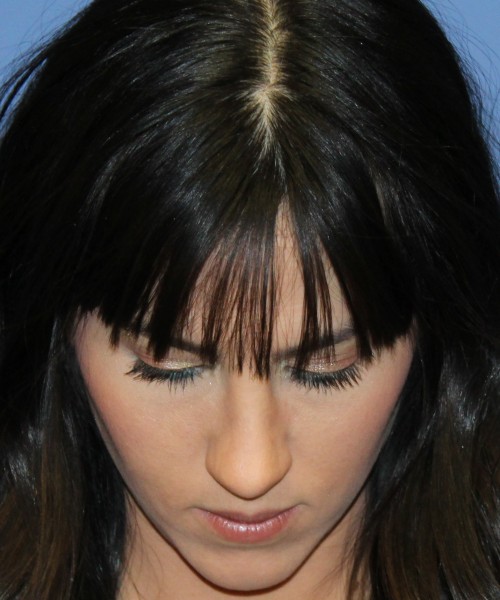 Rhinoplasty 4408 – Click HERE for more views after photo. Individual results may vary.