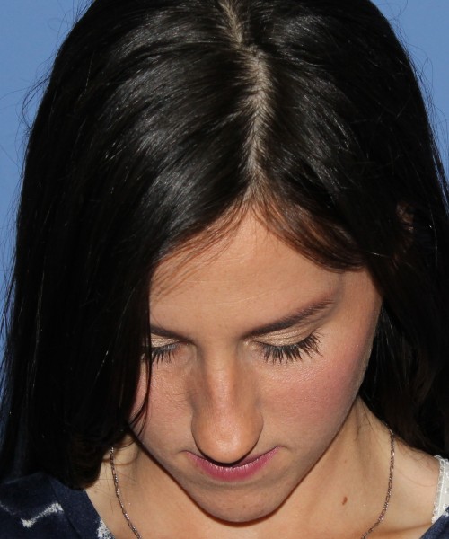 Rhinoplasty 4408 – Click HERE for more views before photo. Individual results may vary.