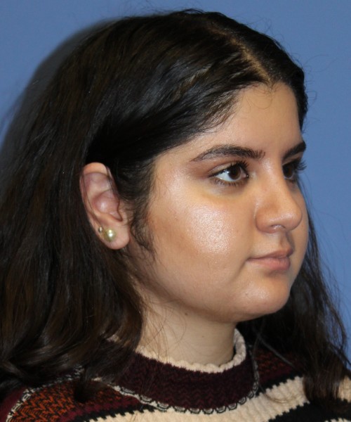 Rhinoplasty 4423 – Click HERE for more views after photo. Individual results may vary.