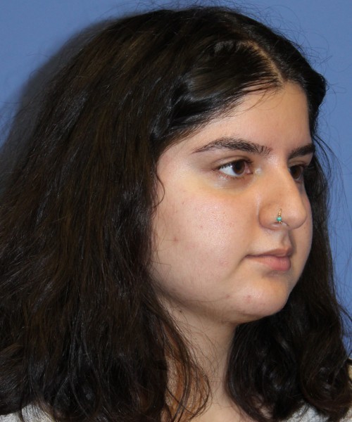 Rhinoplasty 4423 – Click HERE for more views before photo. Individual results may vary.