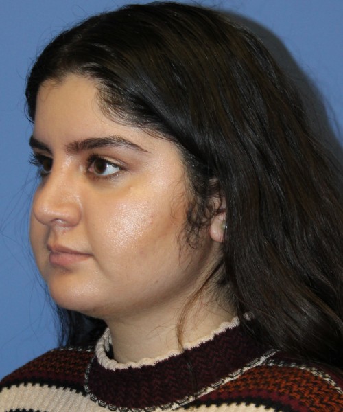 Rhinoplasty 4423 – Click HERE for more views after photo. Individual results may vary.