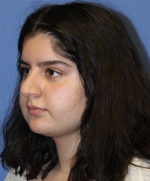 Rhinoplasty 4423 – Click HERE for more views before photo. Individual results may vary.