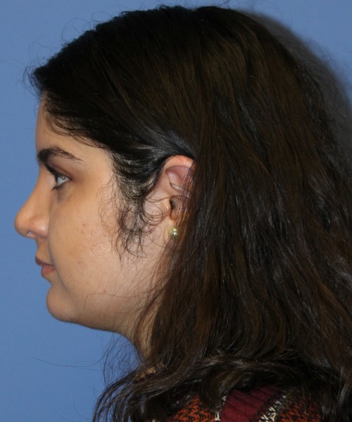 Rhinoplasty 4423 – Click HERE for more views after photo. Individual results may vary.