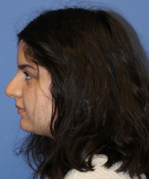 Rhinoplasty 4423 – Click HERE for more views before photo. Individual results may vary.