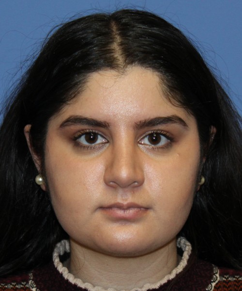 Rhinoplasty 4423 – Click HERE for more views after photo. Individual results may vary.