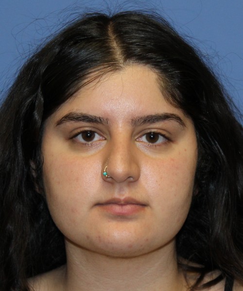 Rhinoplasty 4423 – Click HERE for more views before photo. Individual results may vary.