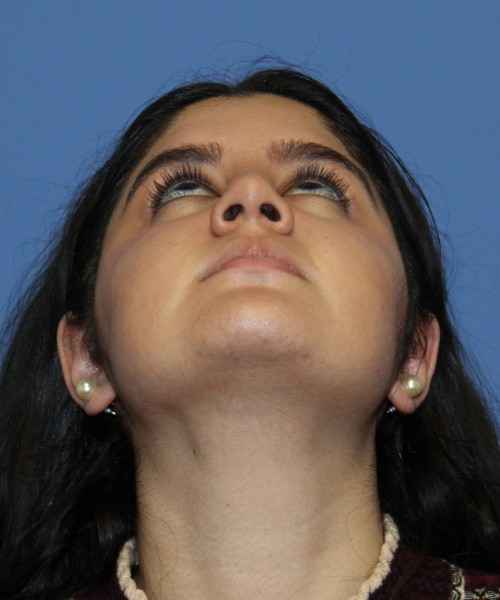 Rhinoplasty 4423 – Click HERE for more views after photo. Individual results may vary.