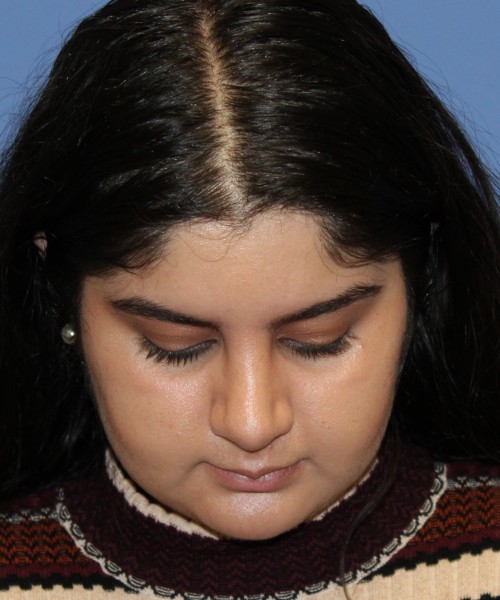 Rhinoplasty 4423 – Click HERE for more views after photo. Individual results may vary.
