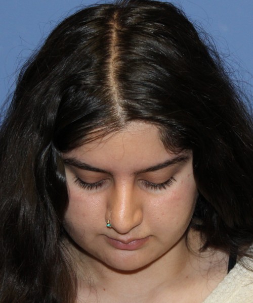 Rhinoplasty 4423 – Click HERE for more views before photo. Individual results may vary.