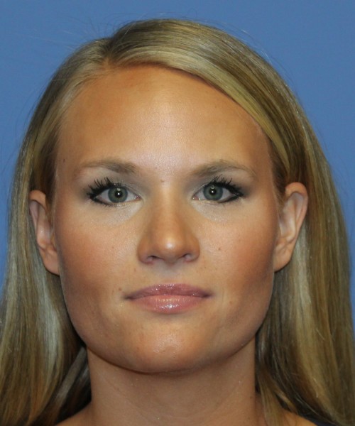 Rhinoplasty 4438 – Click HERE for more views after photo. Individual results may vary.