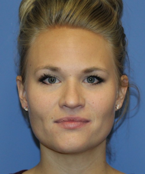 Rhinoplasty 4438 – Click HERE for more views before photo. Individual results may vary.