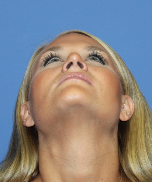 Rhinoplasty 4438 – Click HERE for more views after photo. Individual results may vary.