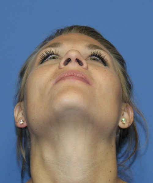 Rhinoplasty 4438 – Click HERE for more views before photo. Individual results may vary.
