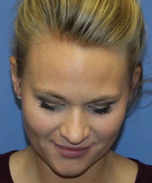Rhinoplasty 4438 – Click HERE for more views before photo. Individual results may vary.
