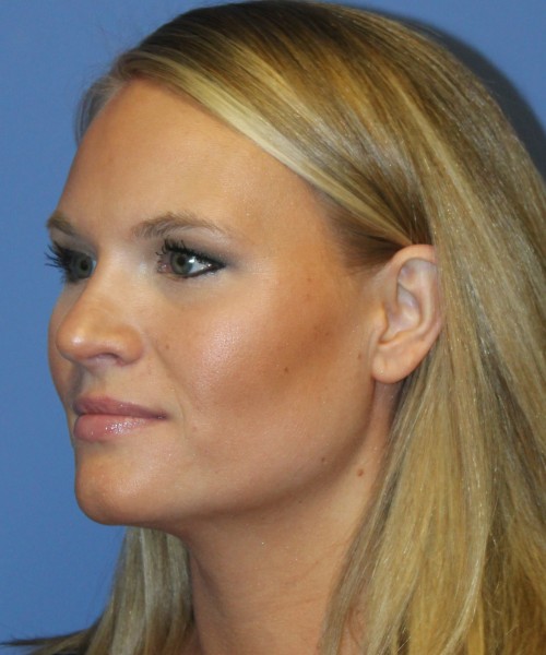 Rhinoplasty 4438 – Click HERE for more views after photo. Individual results may vary.