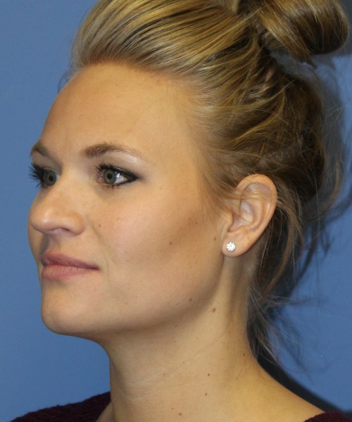 Rhinoplasty 4438 – Click HERE for more views before photo. Individual results may vary.