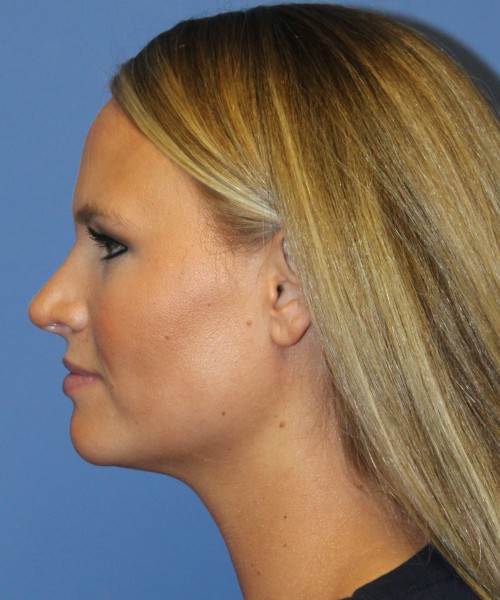 Rhinoplasty 4438 – Click HERE for more views after photo. Individual results may vary.