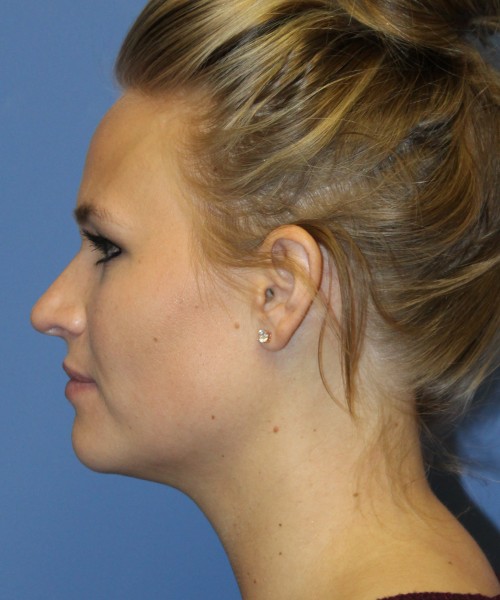 Rhinoplasty 4438 – Click HERE for more views before photo. Individual results may vary.