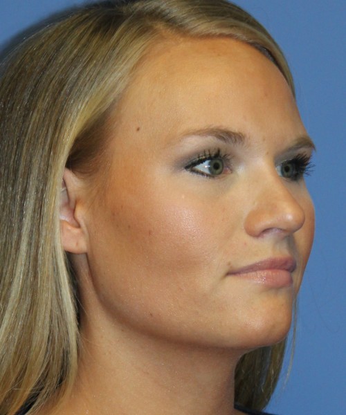 Rhinoplasty 4438 – Click HERE for more views after photo. Individual results may vary.