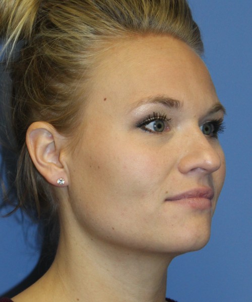 Rhinoplasty 4438 – Click HERE for more views before photo. Individual results may vary.