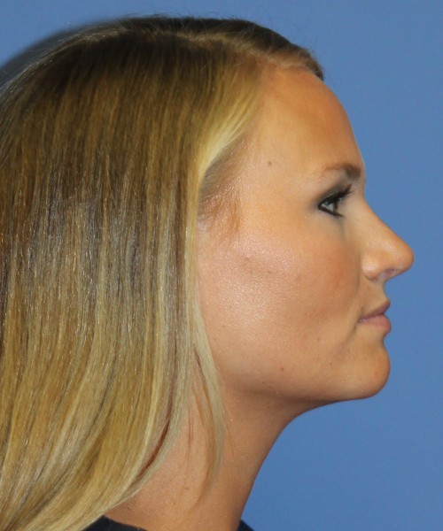 Rhinoplasty 4438 – Click HERE for more views after photo. Individual results may vary.