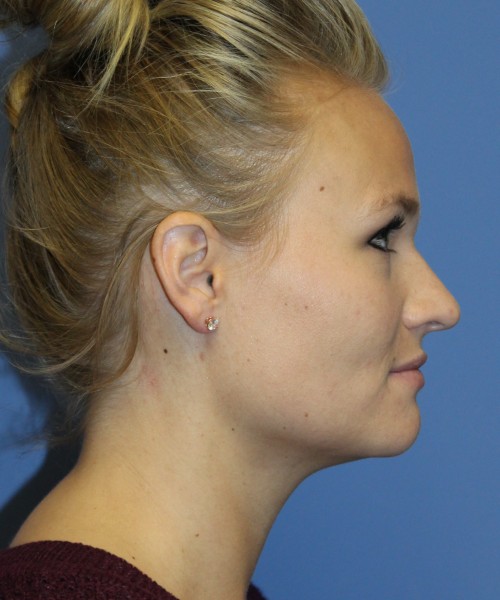 Rhinoplasty 4438 – Click HERE for more views before photo. Individual results may vary.