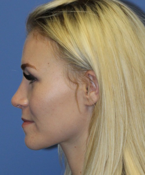 Rhinoplasty 4453 – Click HERE for more views after photo. Individual results may vary.