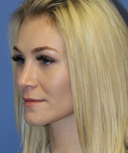 Rhinoplasty 4453 – Click HERE for more views after photo. Individual results may vary.