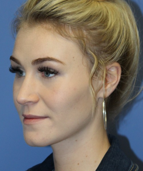 Rhinoplasty 4453 – Click HERE for more views before photo. Individual results may vary.