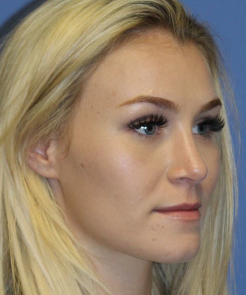 Rhinoplasty 4453 – Click HERE for more views after photo. Individual results may vary.