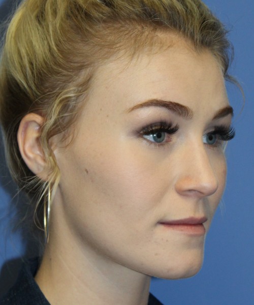 Rhinoplasty 4453 – Click HERE for more views before photo. Individual results may vary.