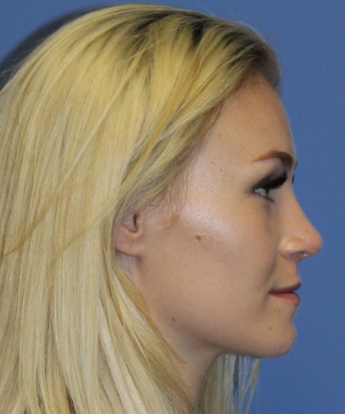 Rhinoplasty 4453 – Click HERE for more views after photo. Individual results may vary.