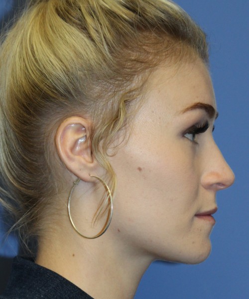 Rhinoplasty 4453 – Click HERE for more views before photo. Individual results may vary.