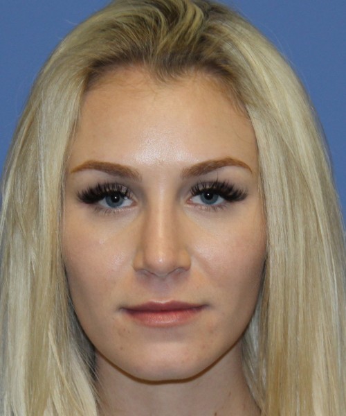 Rhinoplasty 4453 – Click HERE for more views after photo. Individual results may vary.