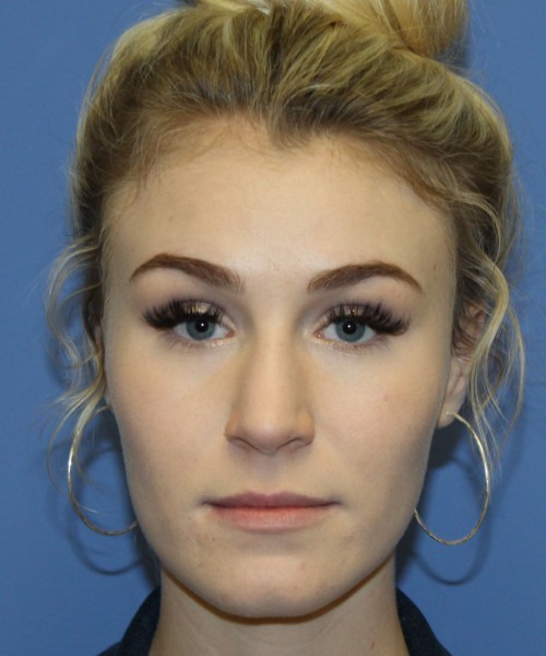 Rhinoplasty 4453 – Click HERE for more views before photo. Individual results may vary.
