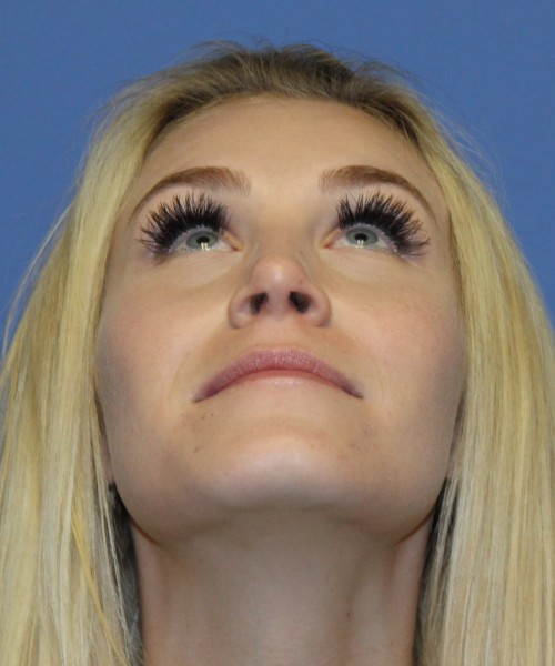 Rhinoplasty 4453 – Click HERE for more views after photo. Individual results may vary.