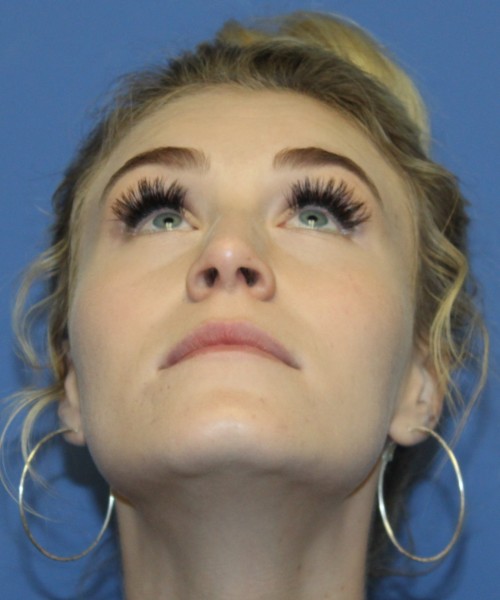 Rhinoplasty 4453 – Click HERE for more views before photo. Individual results may vary.
