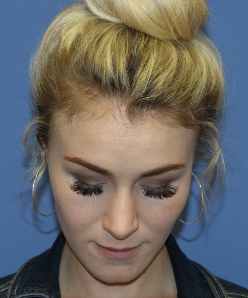 Rhinoplasty 4453 – Click HERE for more views before photo. Individual results may vary.
