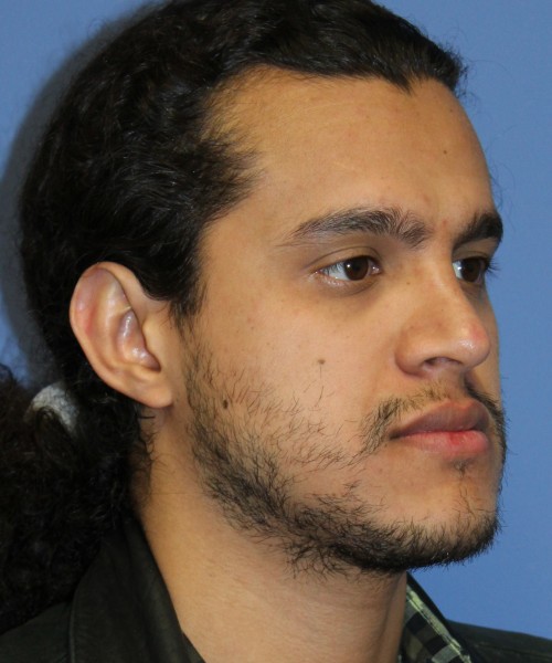 Rhinoplasty 4468 – Click HERE for more views after photo. Individual results may vary.