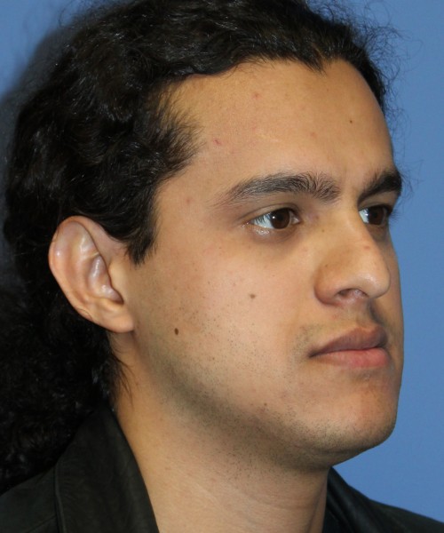 Rhinoplasty 4468 – Click HERE for more views before photo. Individual results may vary.