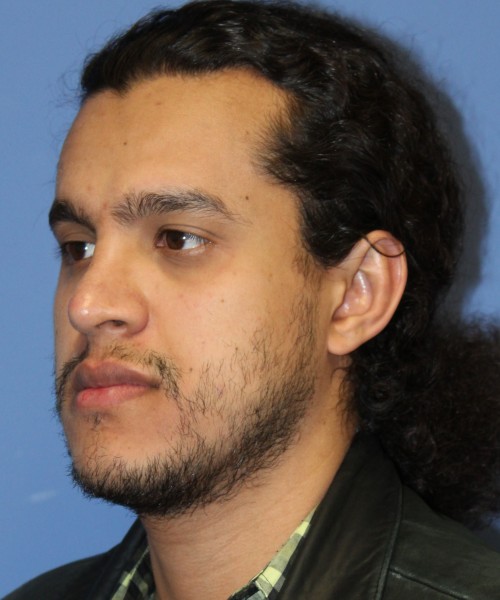 Rhinoplasty 4468 – Click HERE for more views after photo. Individual results may vary.
