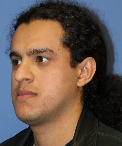 Rhinoplasty 4468 – Click HERE for more views before photo. Individual results may vary.