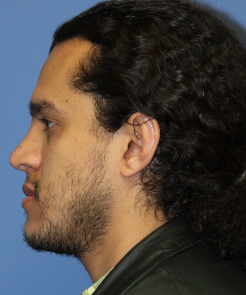 Rhinoplasty 4468 – Click HERE for more views after photo. Individual results may vary.