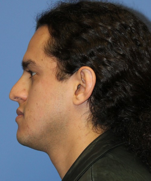 Rhinoplasty 4468 – Click HERE for more views before photo. Individual results may vary.