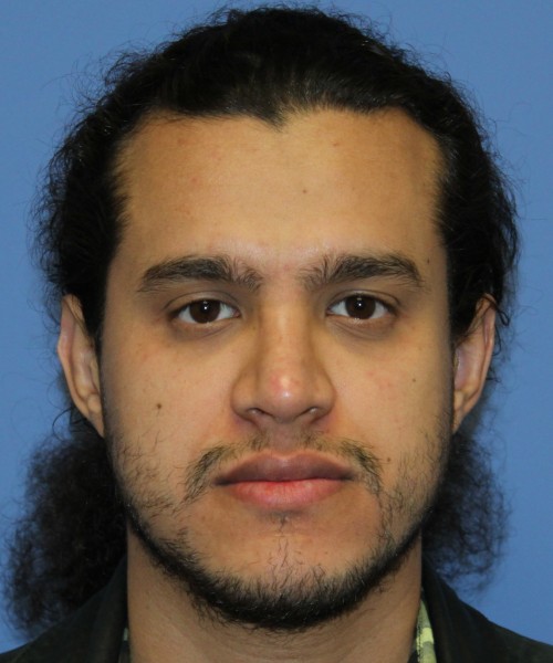 Rhinoplasty 4468 – Click HERE for more views after photo. Individual results may vary.