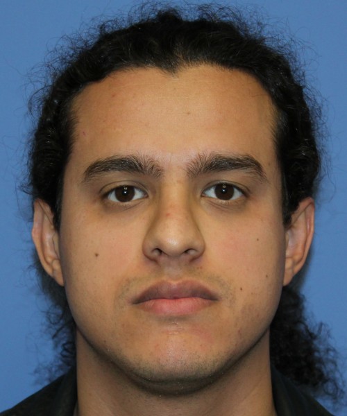 Rhinoplasty 4468 – Click HERE for more views before photo. Individual results may vary.