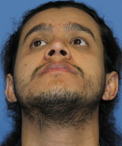 Rhinoplasty 4468 – Click HERE for more views after photo. Individual results may vary.