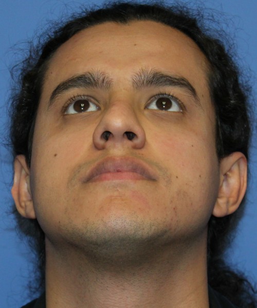 Rhinoplasty 4468 – Click HERE for more views before photo. Individual results may vary.