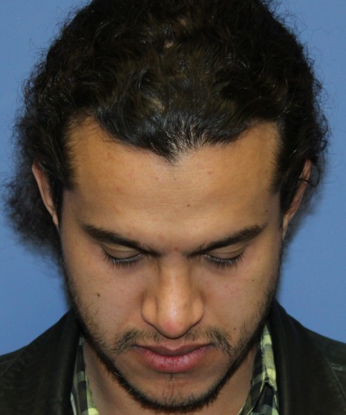Rhinoplasty 4468 – Click HERE for more views after photo. Individual results may vary.